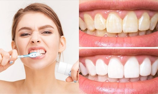 Đánh răng quá nhiều không giúp răng trắng lên mà còn có thể bị ngả vàng. Đồ họa: Nghi Phương.