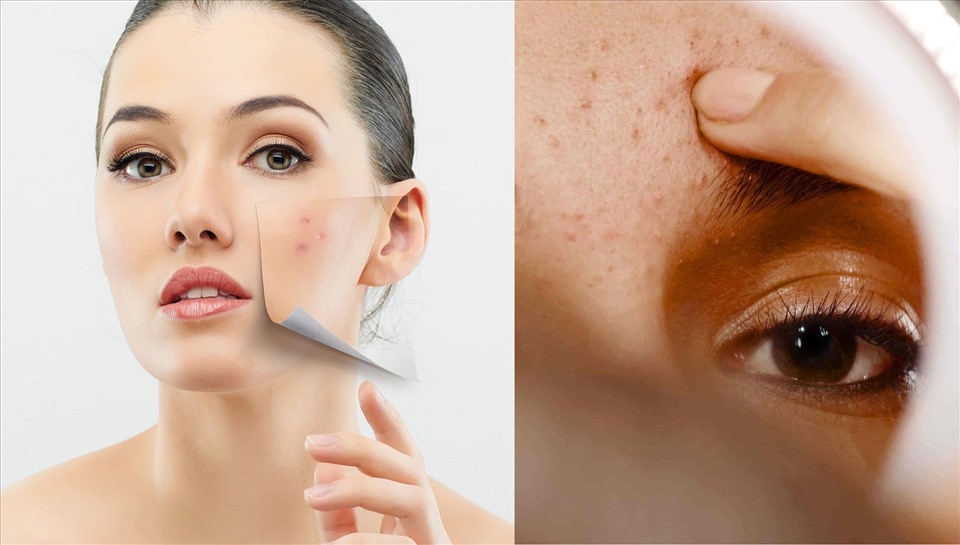 Phục hồi hư tổn do ánh nắng mặt trời cho làn da