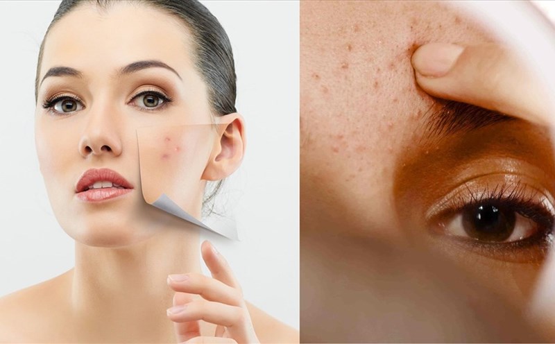 Phục hồi hư tổn do ánh nắng mặt trời cho làn da