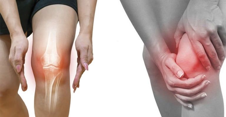 Giảm cơn vi&ecirc;m khớp nhanh ch&oacute;ng với những loại "thực phẩm v&agrave;ng" n&agrave;y