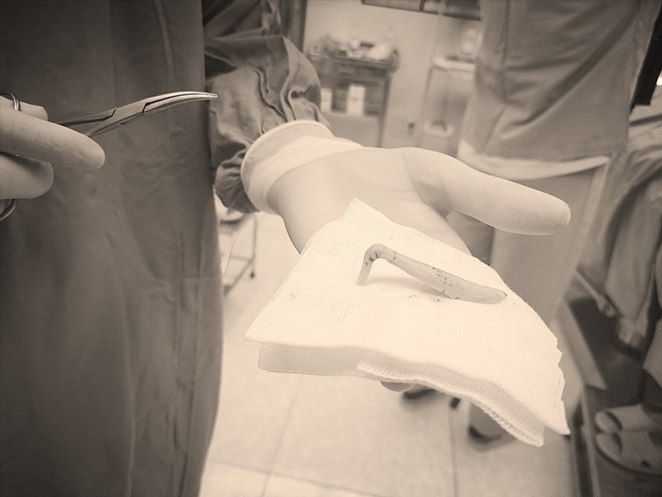 Phần sụn mũi hình chữ "L" được lấy ra từ mũi bệnh nhân. Ảnh: BVCC