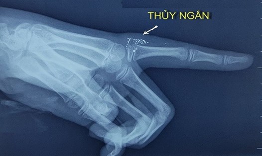 Hạt thủy ngân trong tay qua hình ảnh phim X-quang. Ảnh BVCC