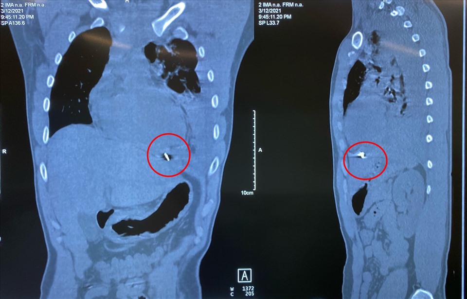 Hình ảnh dị vật nằm trong cơ hoành, dưới tim và ngay trên gan trái của bệnh nhân. Ảnh: BVCC