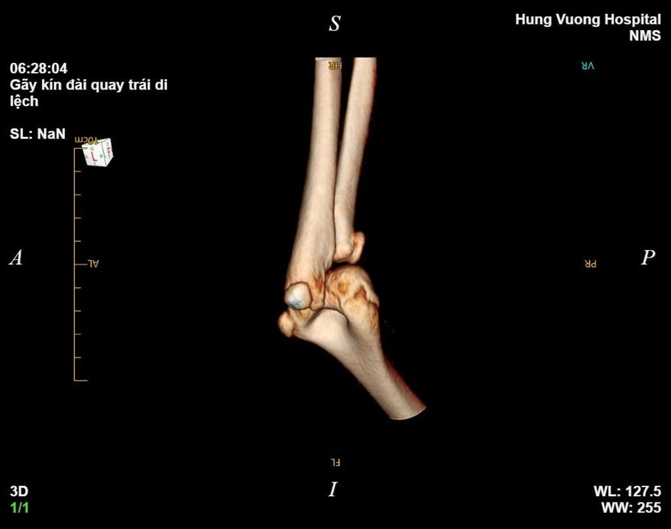 Hình ảnh xương bị gãy của bệnh nhi. Ảnh: BVCC Hình ảnh xương bị gãy của bệnh nhi. Ảnh: BVCC