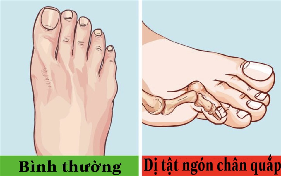 Đi giày cao gót thường xuyên có thể khiến bàn chân gặp phải nhiều rắc rối. Đồ họa: Việt Trinh