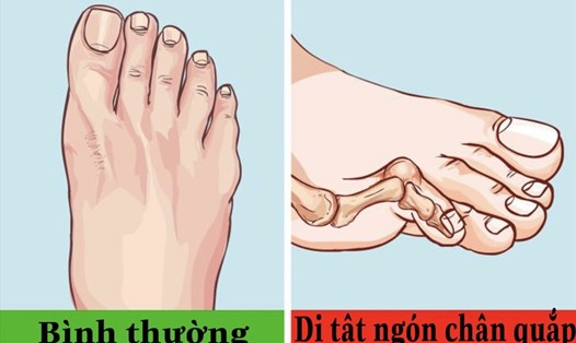 Đi giày cao gót thường xuyên có thể khiến bàn chân gặp phải nhiều rắc rối. Đồ họa: Việt Trinh
