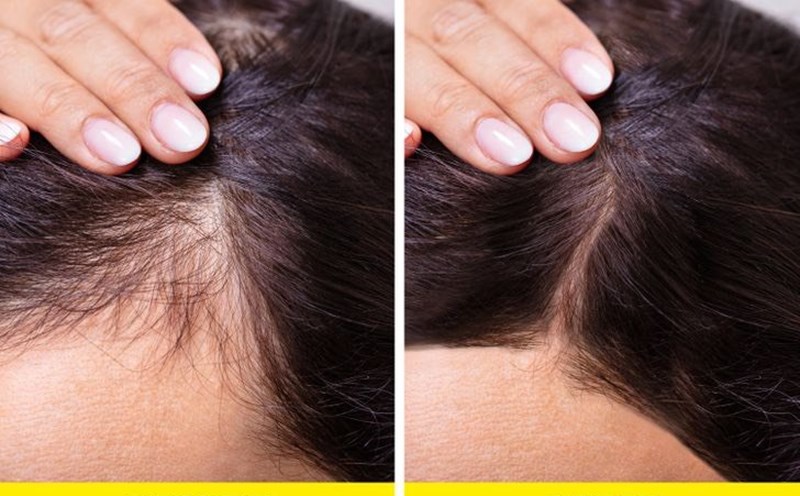10 Cách kích thích mọc tóc nhanh dày và dài hiệu quả tại nhà | Rungtoc.vn