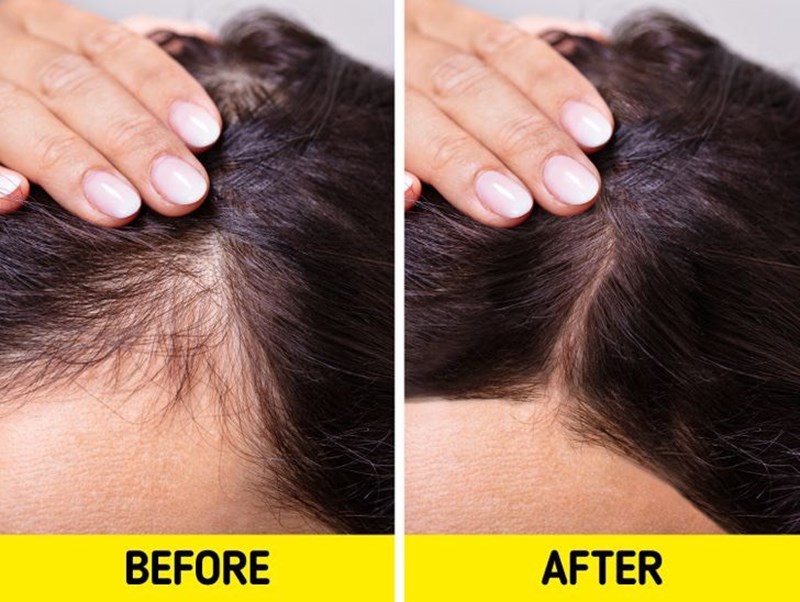 12 Cách mọc tóc nhanh cho nam giới tại nhà trong 7 ngày | Shynh Beauty
