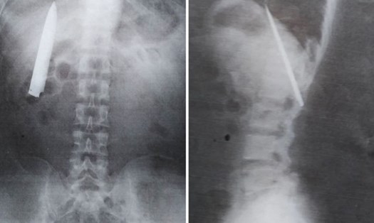 Ảnh chụp X-quang cho thấy có một con dao đang nằm trong cơ thể Tomao. Ảnh: Coconuts.co