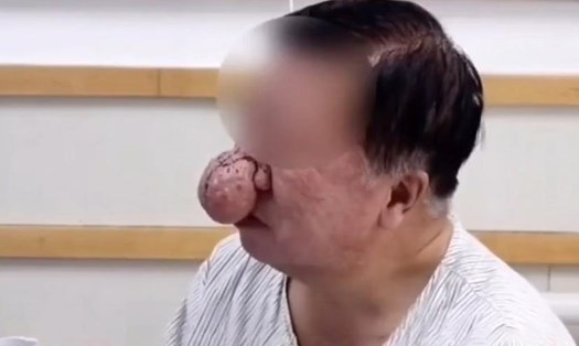 Mũi của người đàn ông Trung Quốc đã trở nên quá khổ do nghiện rượu trong thời gian dài. Ảnh: AsiaWire / Australscope