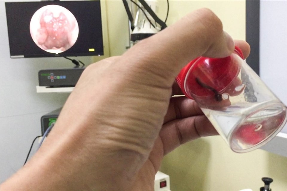 Gắp thành công con vắt cho người bệnh có thói quen uống nước suối Gắp thành công con vắt cho người bệnh có thói quen uống nước suối