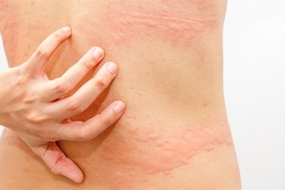 Các bệnh thường gặp ở da phòng ngừa và chẩn đoán sớm. Ảnh minh họa. Các bệnh thường gặp ở da phòng ngừa và chẩn đoán sớm. Ảnh minh họa.