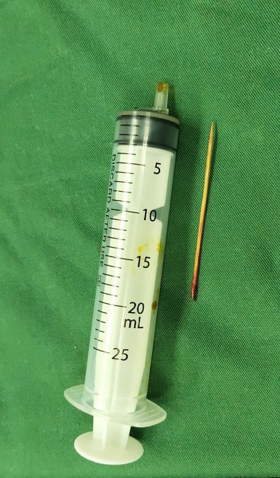 Dị vật là chiếc tăm sau khi được các bác sĩ lấy ra khỏi cơ thể của người bệnh. Ảnh: BVCC Dị vật là chiếc tăm sau khi được các bác sĩ lấy ra khỏi cơ thể của người bệnh. Ảnh: BVCC