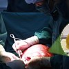 Một ca phẫu thuật u xơ tử cung tại Bệnh viện Phụ sản Hà Nội. Ảnh: BVCC