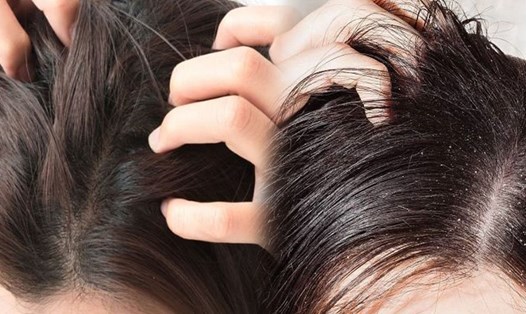 5 nguyên nhân phổ biến khiến da đầu bị ngứa. Đồ hoạ: Vy Vy