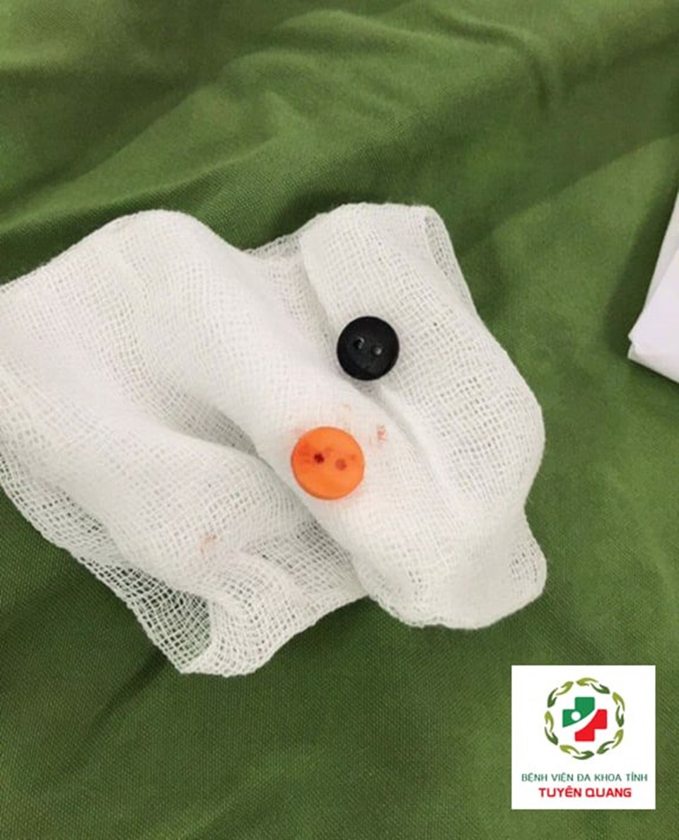 Dị vật là cúc áo được lấy ra. Ảnh: BVCC Dị vật là cúc áo được lấy ra. Ảnh: BVCC