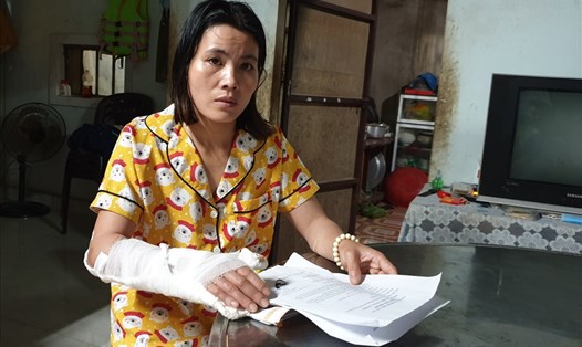 Sau khi bị tai nạn lao động, do không được đóng BHXH, bà Dung gặp nhiều khó khăn vì cánh tay gần như bị liệt. Ảnh: Hưng Thơ.