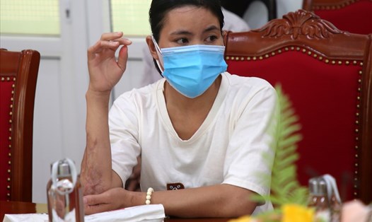 Nữ công nhân Trần Thị Dung với cánh tay sau tai nạn lao động. Ảnh: Hưng Thơ.