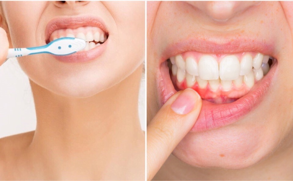 Việc vệ sinh sai cách có thể dẫn đến những bệnh lý răng miệng khó chịu. Ảnh minh hoạ: An An.