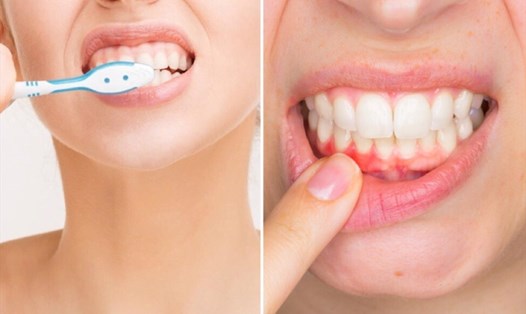 Việc vệ sinh sai cách có thể dẫn đến những bệnh lý răng miệng khó chịu. Ảnh minh hoạ: An An.