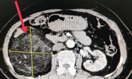 Khối u của người bệnh trên hình ảnh chụp CT.Scanner. Ảnh: BVCC