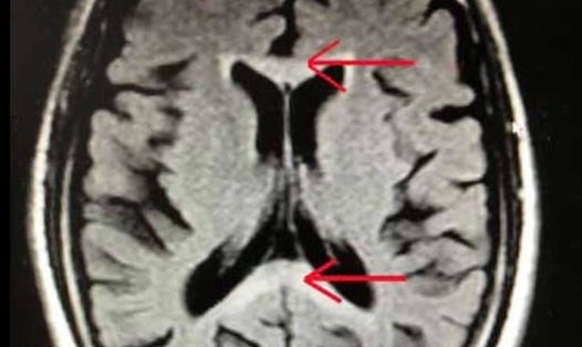 Hình ảnh MRI sọ não cho thấy tổn thương phù tế bào đối xứng hai bên đuôi
thể chai (vị trí mũi tên chỉ)