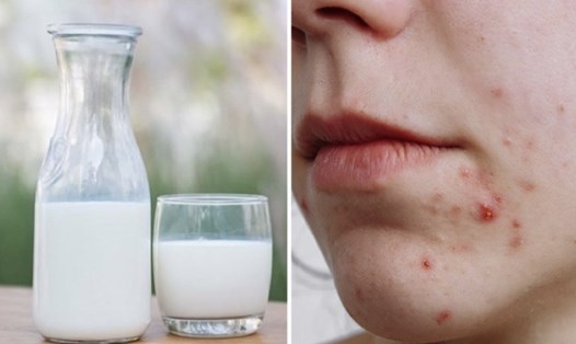 Sữa có làm tăng khả năng bị mụn trứng cá hay không còn phụ thuộc lớn vào cơ địa và loại da.
