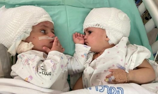 Cặp song sinh bé gái 1 tuổi ở Israel sau ca phẫu thuật tách dính thành công. Ảnh: Soroka Medical Center