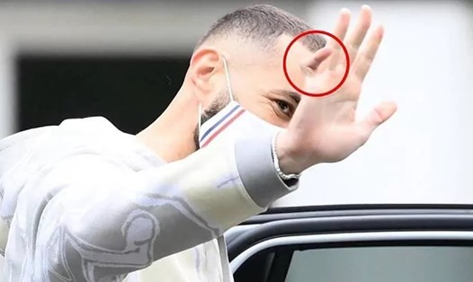 Ngón tay bị đau trong gần 3 năm của Benzema. Ảnh: AFP.