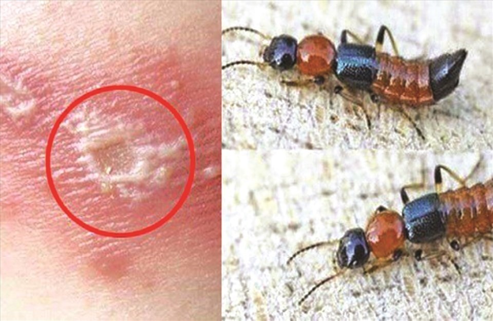 Tổn thương da do kiến ba khoang "tấn công". Ảnh: LĐO