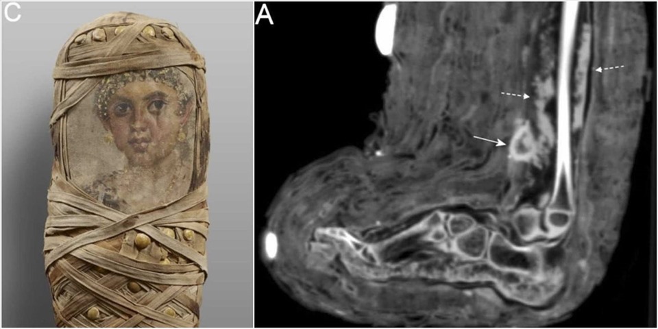 Egyptian mummies with bandaged wounds reveal ancient medical secrets