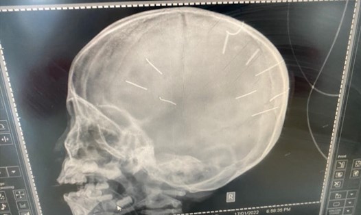 Hình ảnh 9 đinh ghim găm vào sọ cháu bé 3 tuổi ở Thạch Thất. Ảnh: BVCC