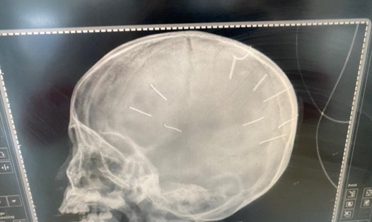 Hình ảnh dị vật bất thường trong sọ não của bé gái 3 tuổi ở Thạch Thất. Ảnh: BVCC