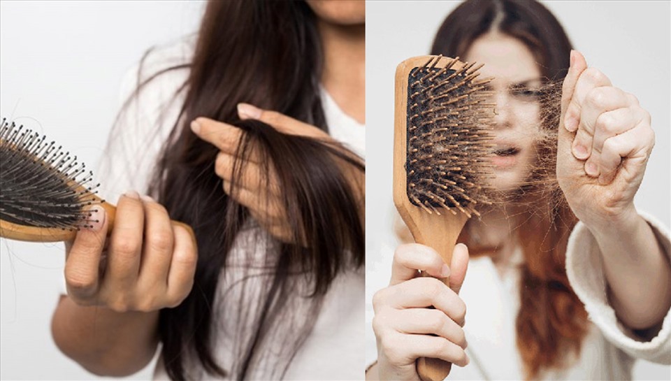 Rụng tóc quá nhiều ở nữ và cách khắc phục hiệu quả nhất