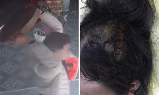 Người phụ nữ 51 tuổi ở Thái Bình bị 2 kẻ côn đồ hành hung, ném thớt vào đầu dẫn đến chấn thương nặng. Ảnh: CTV