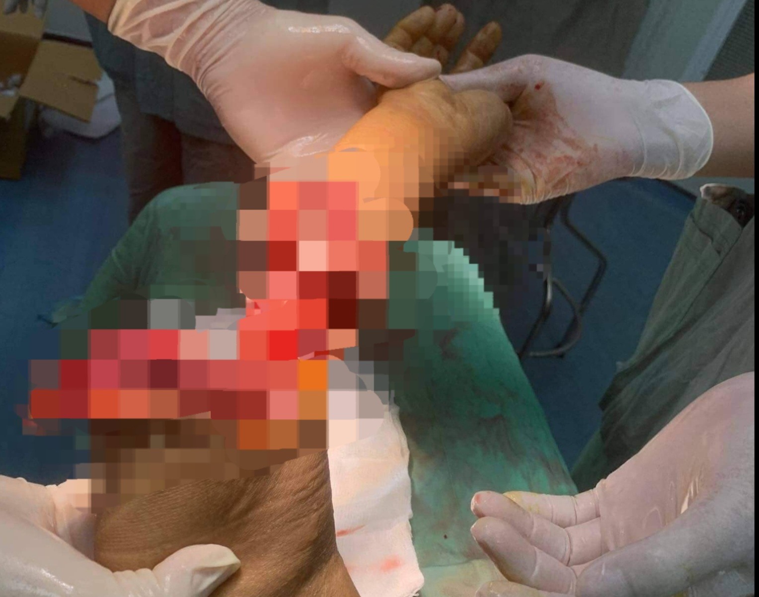 Phẫu thuật thành công trường hợp đứt gần lìa cẳng tay do bị cưa cắt