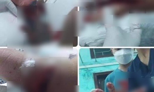 Bố và cậu ruột cô gái ở TP Thái Bình bị bạn trai chém đa chấn thương ở tay. Ảnh: CTV