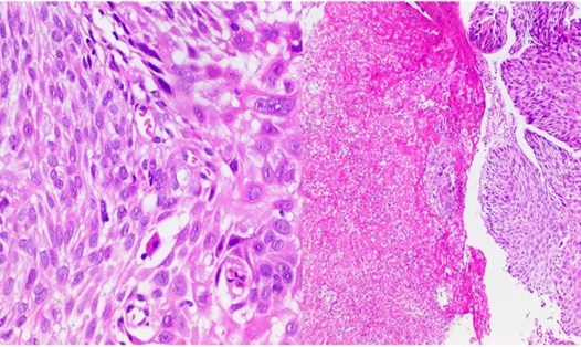 Kết quả sinh thiết vi thể phát hiện ung thư ở bệnh nhân Nguyễn Văn S. Ảnh: BVCC