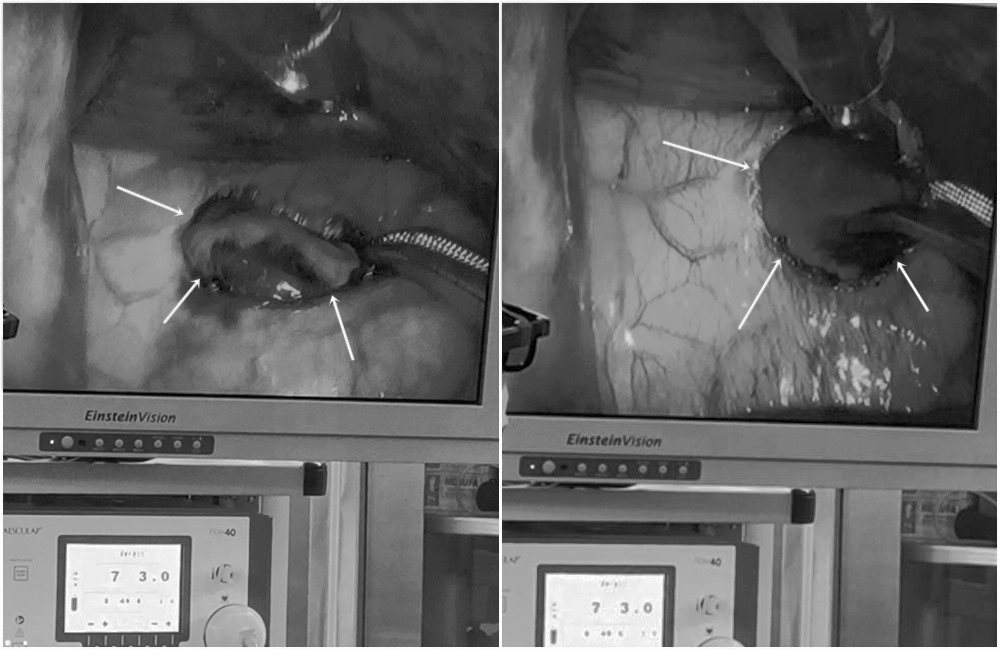 Lỗ thủng trên màng tim qua hình ảnh nội soi. Ảnh: CTV