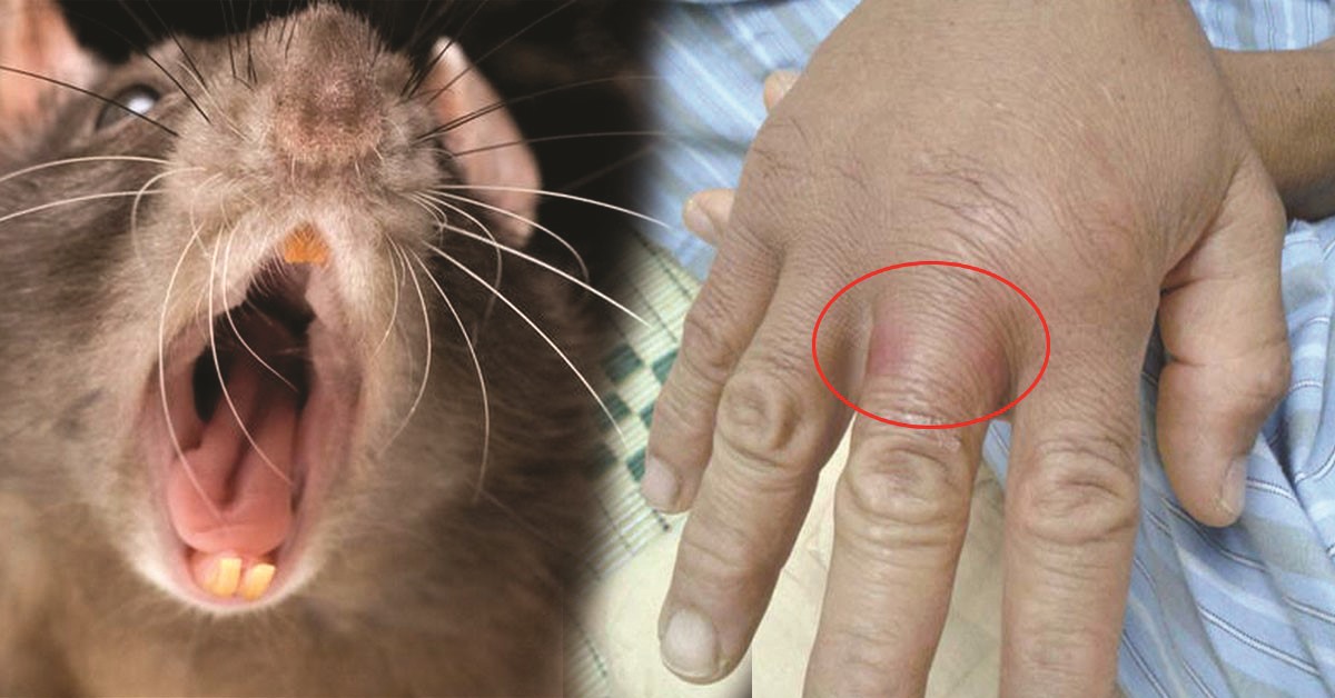 Vết thương do chuột cắn. Ảnh: BVCC