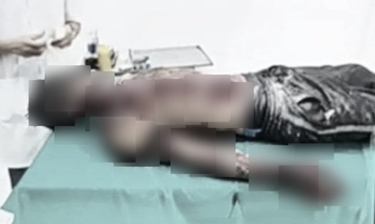 Thợ hàn xì ở Thái Bình nhập viện cấp cứu trong tình trạng đa vết thương sau vụ nổ bình oxy. Ảnh: CTV