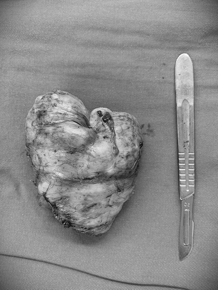 Khối u được lấy ra. Ảnh: BVCC