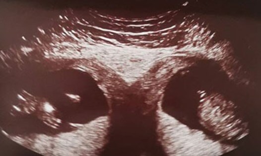 Hình ảnh siêu âm của thai đôi nằm tại hai tử cung khác nhau. Ảnh minh họa: Bệnh viện cung cấp