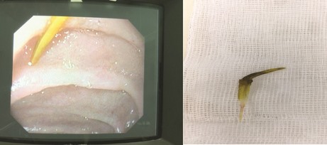 Hình ảnh dị vật xương cá ở đường tiêu hoá. Ảnh: BVCC