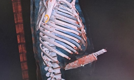 Hình ảnh chụp X-Quang cây dao dài hơn 20cm đâm vào bụng người bệnh. Ảnh: CTV