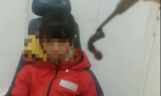 Các bác sĩ đã gắp ra một con vắt dài khoảng 7cm, to gần bằng đầu đũa sống ngoe nguẩy trong mũi bệnh nhi. Ảnh: Trung tâm Y tế huyện Tiên Yên