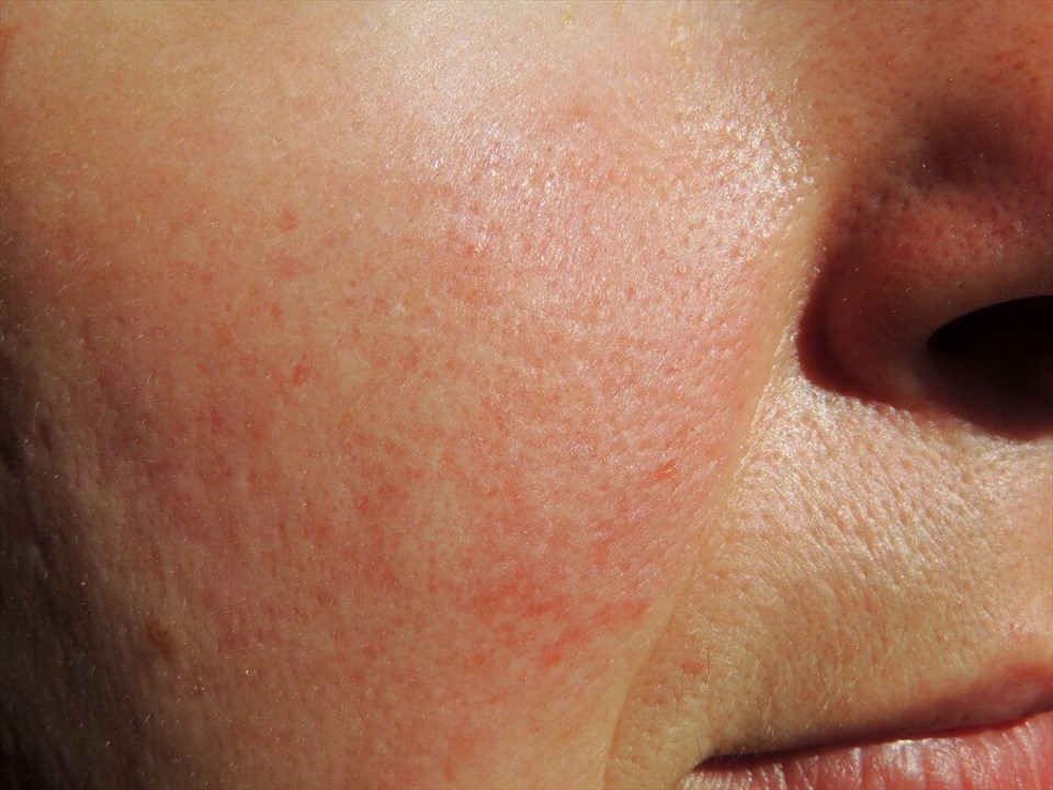 7 nguyên nhân gây đỏ mặt và cách khắc phục
