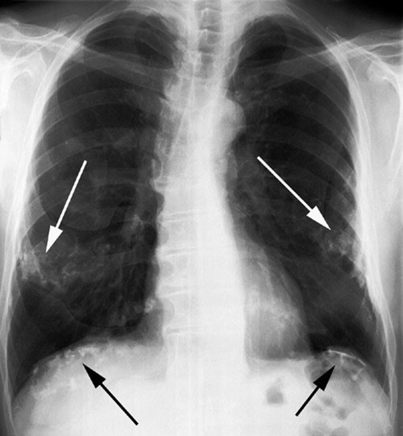 Những biến chứng có thể xảy ra khi không điều trị xơ phổi nhẹ?
