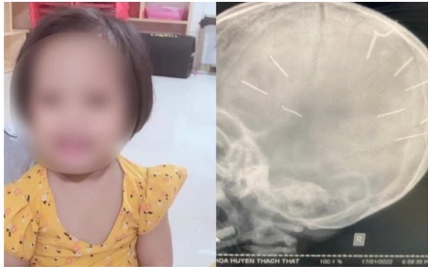 Bác sĩ lý giải nguyên nhân tử vong của bé 3 tuổi bị đóng đinh vào đầu