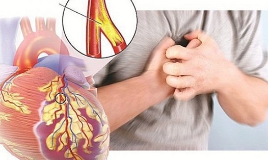 Hội chứng hậu COVID-19 có thể làm gia tăng nguy cơ mắc bệnh tim mạch.